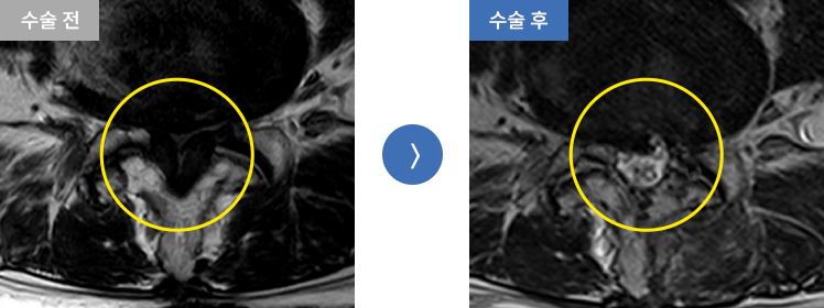 양방향 내시경술 수술 전후 case01